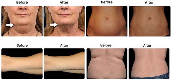 Doctorfatoff Coolsculpting Consultation